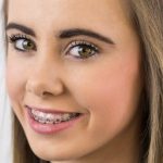 Riješite nesavršenosti zuba ortodontskim aparatom